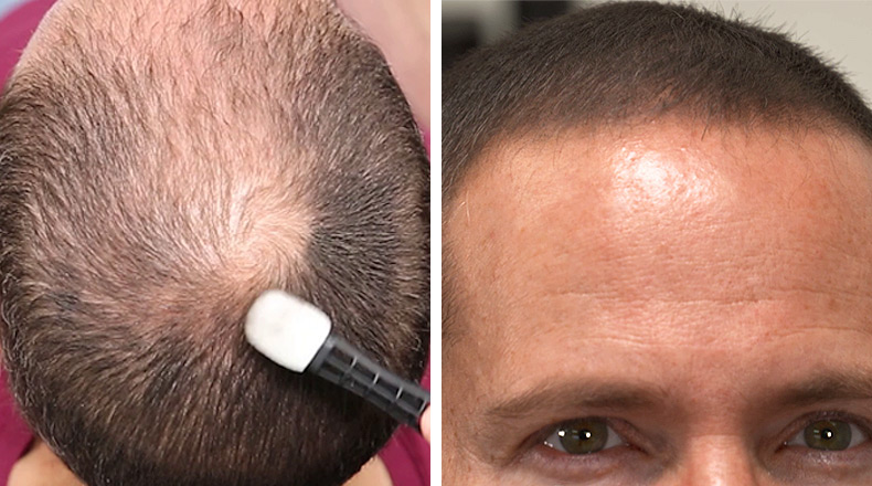 DermMatch Hair Loss Concealer - Great For Thin Hair Or Small Bald Spots