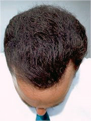 Bad transplant enhanced with DermMatch. Bad transplant enhanced with DermMatch.