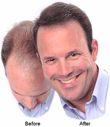 Cover Bald DermaMatch